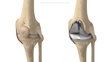 Total knee replacement pictures
