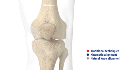 Knee replacement kinematic alignment picture
